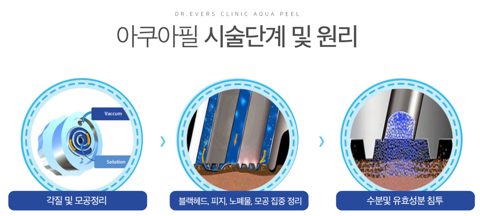 아쿠아필 원리 강남피부과 닥터에버스